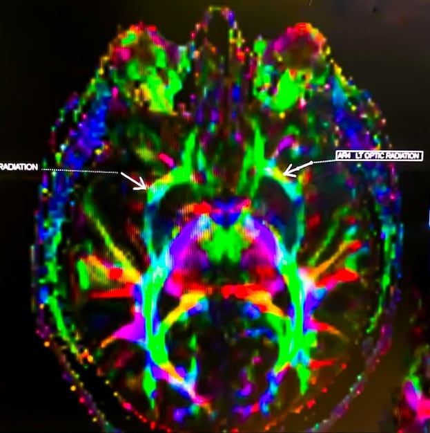 A close-up of brain scan images showcasing activity changes in regions associated with attention, emotional regulation, and self-awareness during mindfulness practice. The colors highlight active areas related to meditation and mindfulness.